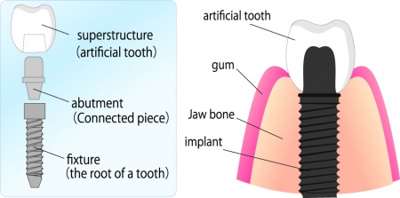 dental implants