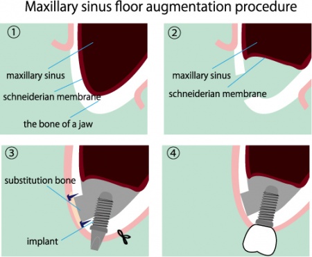 Sinus Lift